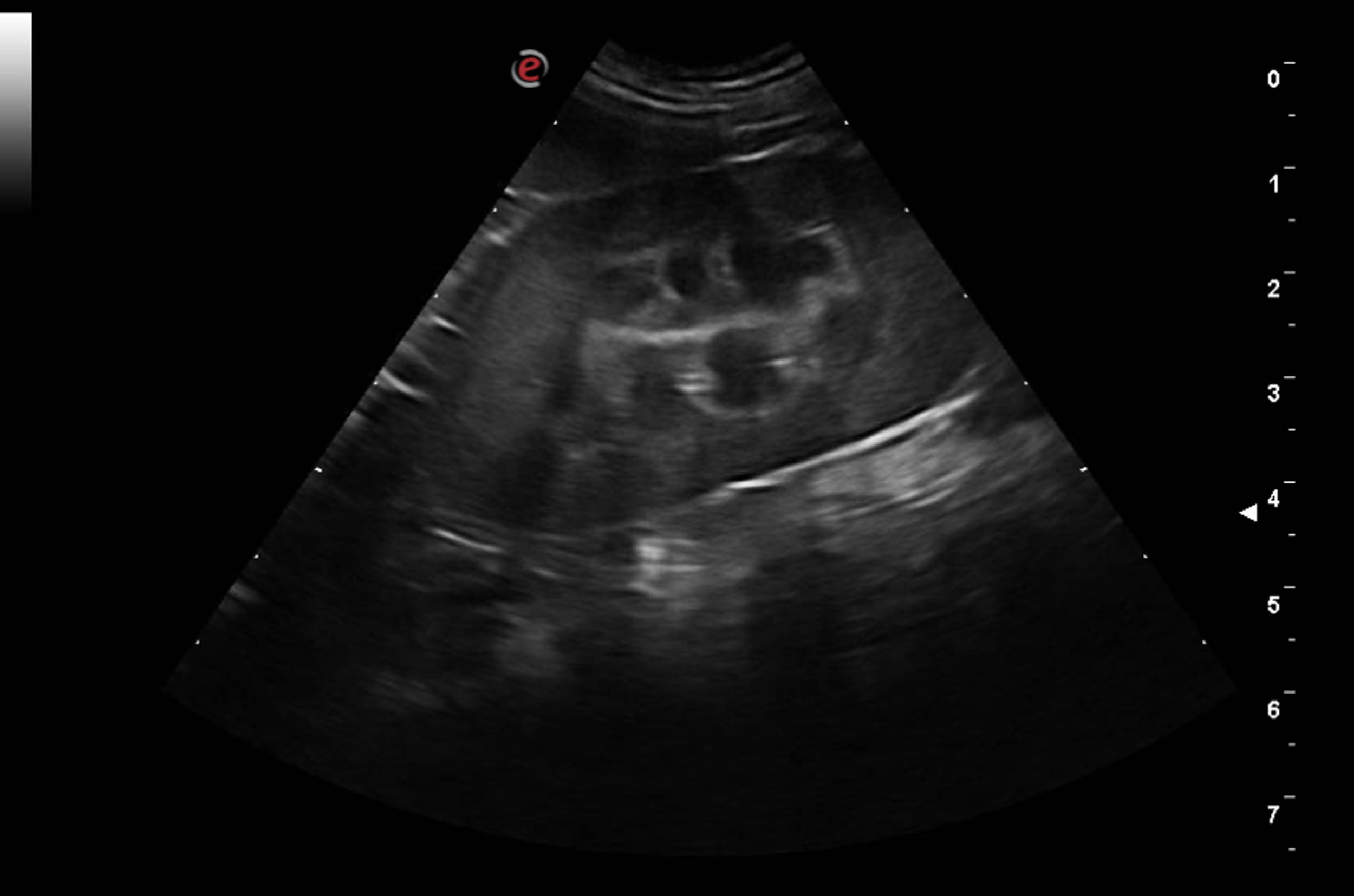 Ultraschall Niere